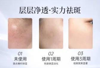 2026轻微点状小斑点慢慢加深用什么面霜最及时？后西施美白祛斑霜，提前阻断色素避免色斑变顽固